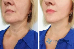 Double chin before and after Hi-Fu treatment 4 Book your double chin treatment Westminster today! We are here to help!