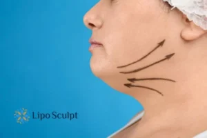 Double chin before and after Hi-Fu treatment 3 Boost your confidence with a Double chin treatment Westminster