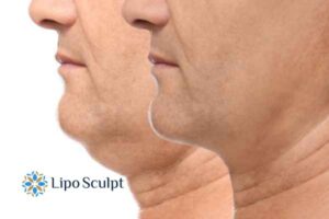 Double chin before and after Hi-Fu treatment 2 Double chin treatment Westminster from Lipo Sculpt - feel more confident today!