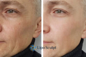 How to Fight Aging Symptoms 3 Fight Aging Symptoms Westminster With HIFU and Morpheus8 Today!