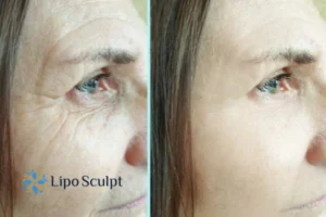 How to Fight Aging Symptoms 2 Do you want to Fight Aging Symptoms Westminster? Contact Lipo Sculpt today!